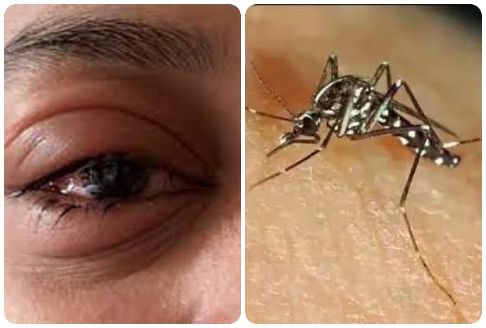 NCDRC: Absolves Ophthalmologist, attributes vision lose to dengue