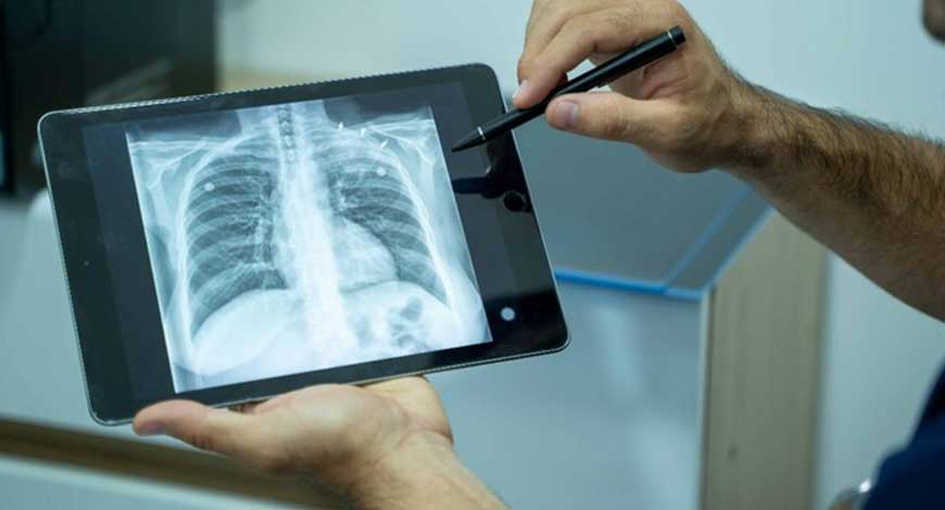 India develops indigenous hand held X-Ray for TB screening