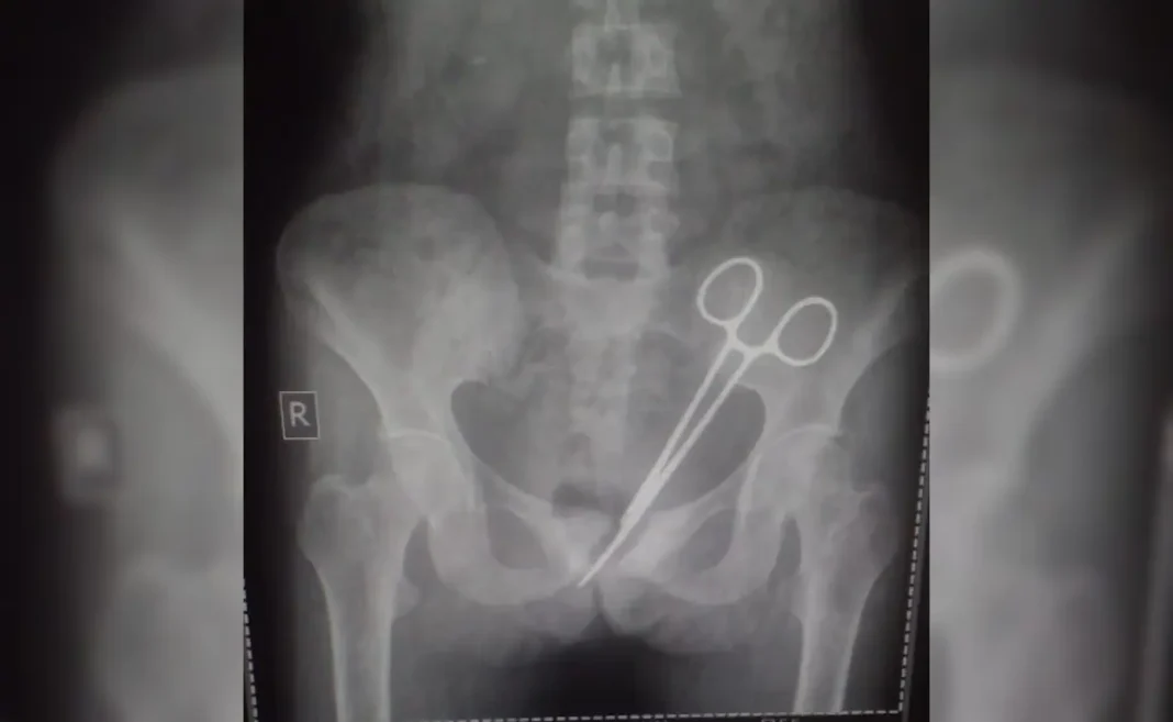 Surgical scissor found in patient abdomen after 12 years in STNM, Gangtok