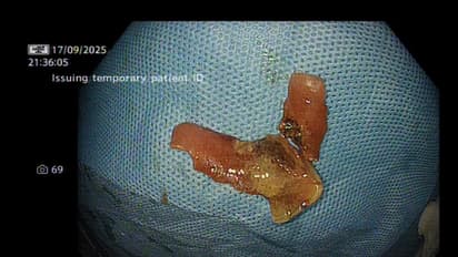 Breakthrough at Sir Ganga Ram: Holmium Laser Used to Fragment and Remove Lodged Dental Plate